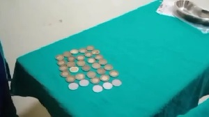 इस बीमारी में सिक्के खाने लगता है शख्स… डॉक्टरों ने पेट की सर्जरी कर निकाले 33 Coins…